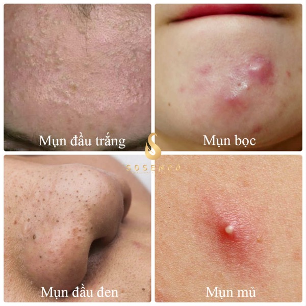 serum trị mụn mờ thâm