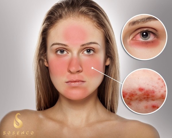 serum trị mụn thâm cho da dầu