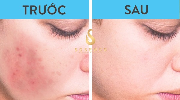 sữa rửa mặt gel trị mụn