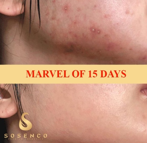serum trị thâm ngừa mụn
