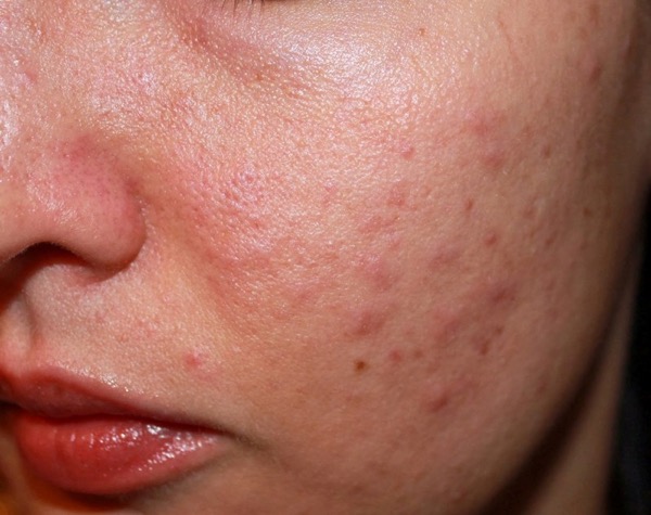 serum trị mụn và thâm tốt nhất