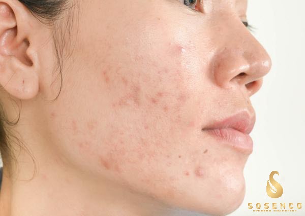 Serum trị mụn thâm cho da dầu