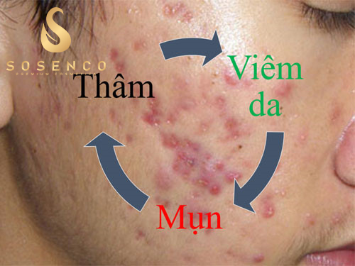 Serum trị mụn thâm lâu năm - Lâu năm vẫn hết