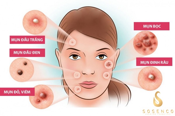 Các loại mụn thường gặp nên dùng serum trị mụn mờ thâm