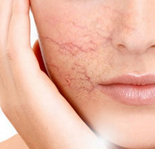 Cảnh Giác 3 Tác Hại Khôn Lường Của Rượu Thuốc Trị Mụn