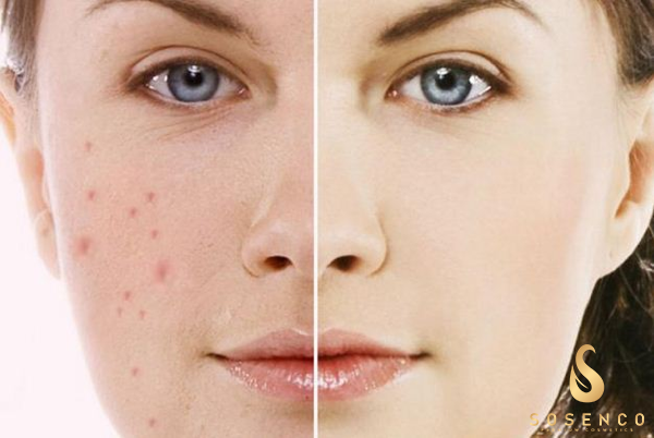 Mách bạn cách lựa chọn serum trị mụn và thâm chất lượng