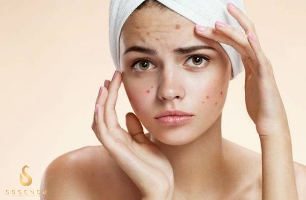 Nguyên nhân chính gây ra mụn và chọn serum đặc trị mụn hiệu quả nhất