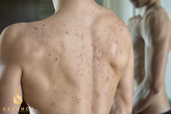 Nguyên nhân và cách điều trị mụn lưng với sữa tắm trị mụn lưng cho nam