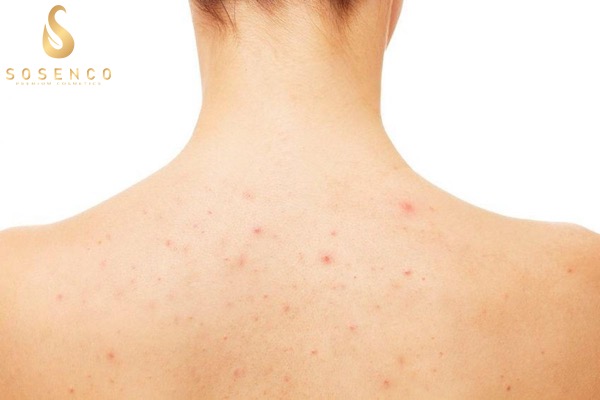 Những nguyên nhân và cách chọn serum trị thâm mụn lưng