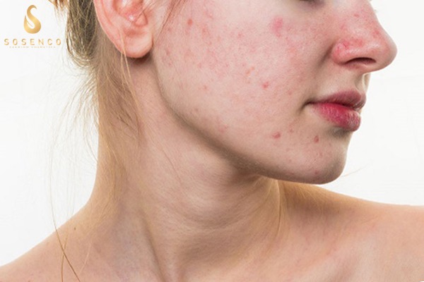 Ưu điểm tuyệt vời của serum đặc trị mụn Wicbe